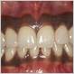 black gums gum disease