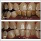 black tartar on teeth and gum disease