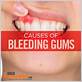 bleeding from gums causes