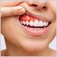 bleeding gums and bad breath treatment