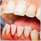 bleeding gums cause