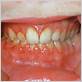 bleeding gums crohn's disease