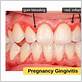 bleeding gums early pregnancy