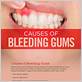 bleeding gums sign