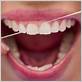 bleeding gums when flossing and bad smell