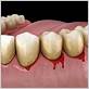 bleeding when flossing dental implant