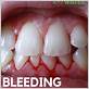 blood after water flossing