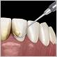 blue bell gum disease treatment