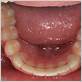 bonded retainer gum disease