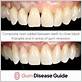 bonding teeth with gum disease