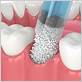 bone graft dental chewing