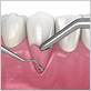 bone graft for a gum not caused by periodontal disease