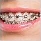 braces and gum disease