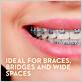 bridges and wide gaps floss for braces henry schein dental
