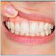 calcium therapy gum disease