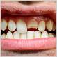 can a broken tooth cause gum disease