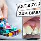 can antibiotics help with gum disease