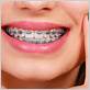 can braces help gum disease