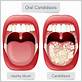 can candida cause gum disease