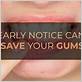 can chewing gum carry disease