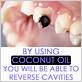 can coconut oil reverse gum disease