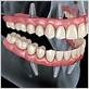 can dental implanted mollar chew meat