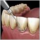 can dentist fix gum disease