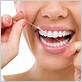 can flossing whiten teeth