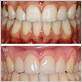 can gingivitis be reversed