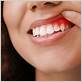 can gum disease affect the roof of your mouth