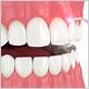 can gum disease be cured with lanap