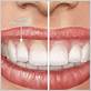 can gum disease be reversed naturally