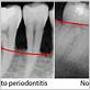 can gum disease be seen in x ray