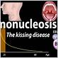 can gum disease be transmitted by kissing