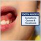 can gum disease cause abscess