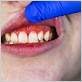 can gum disease cause grainy gums