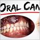 can gum disease cause mouth cancer