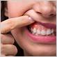 can gum disease cause mouth sores