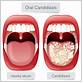 can gum disease cause oral thrush