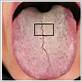 can gum disease cause tongue coating