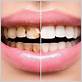 can gum disease damage be reversed