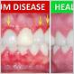can gum disease make you spit blood