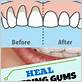 can gums heal
