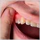 can gums recover from gum disease