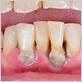 can gums regrow after gum disease