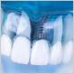 can have dental implants gum disease