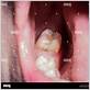 can i chew gum after dental extraction