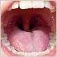 can i get tonsillitis from gum disease