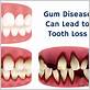 can i lose my teeth from gum disease