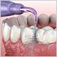 can i use a water flosser after tooth extraction